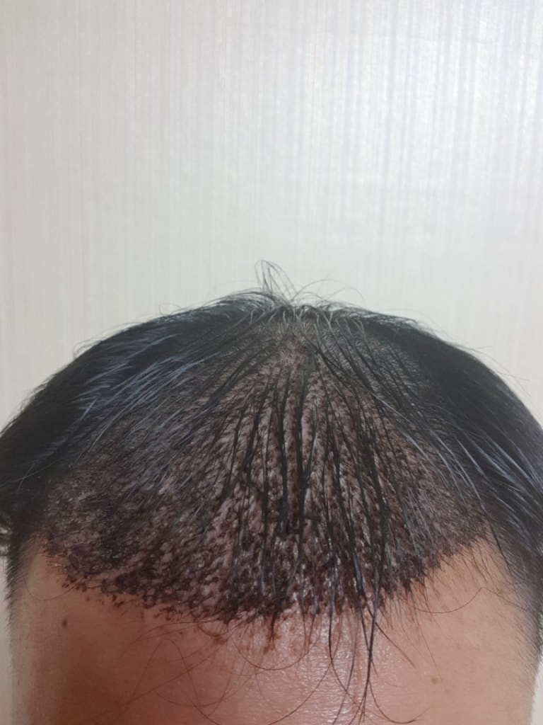 上周四做了手术！