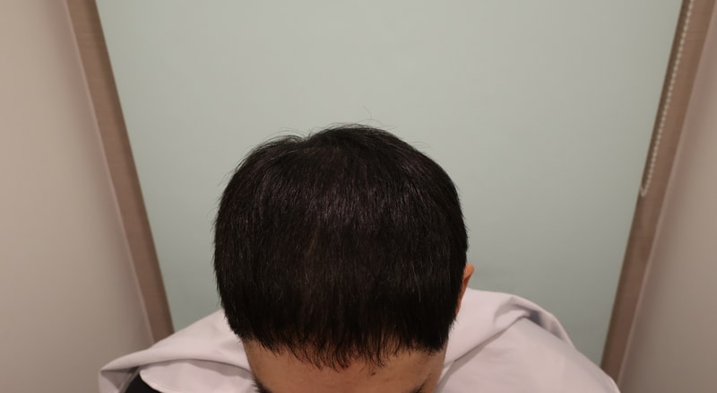前豆腐 5000毛 毛髪移植 4ヶ月目