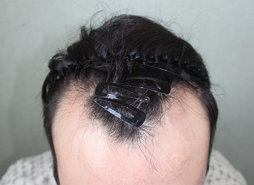 Deep emza and wide forehead.... About 4,000 hair transplants from Hanive