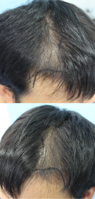 Because of the M-shape that was badly cut above, I got a transplant from Hannaive