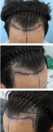 I got an M-shaped hair transplant from Hannaive Hair Transplantation Center