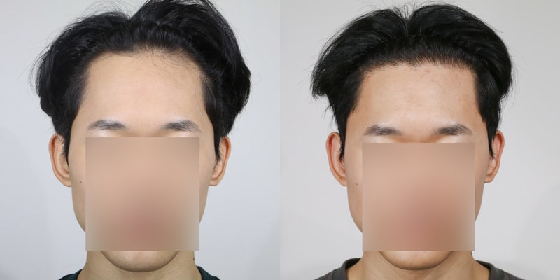 Apgujeong Mo Woo-rim's 2300 hair incision transplant surgery photo review / 2nd year