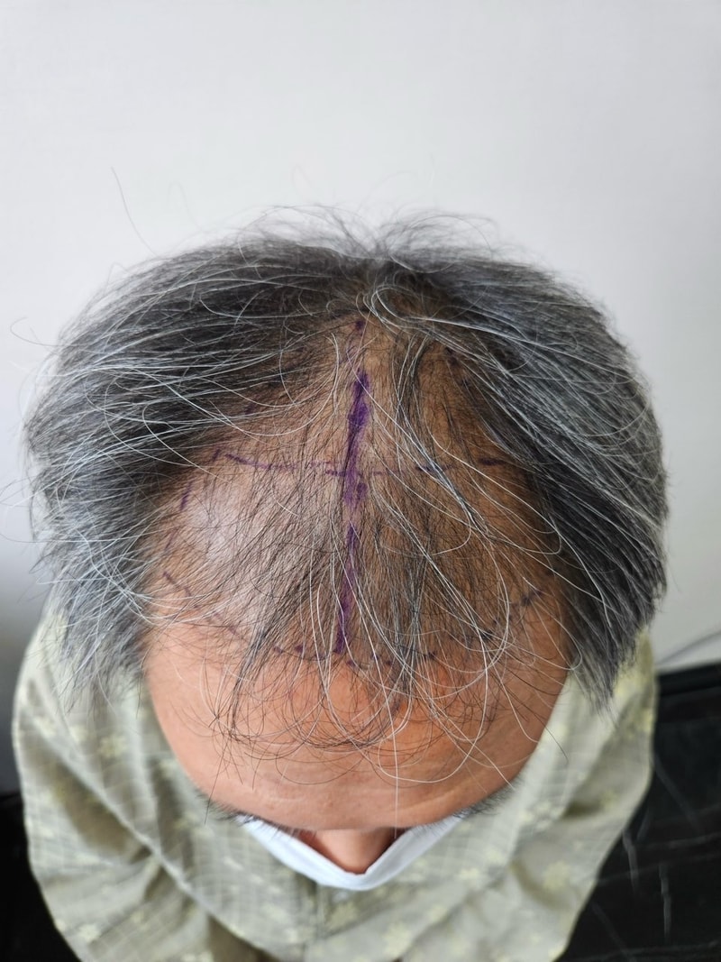 모발이식 성공 후 12개월 후기~~!