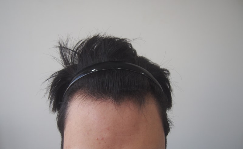 비절개 수술직후 후기입니다.
