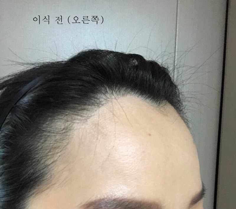 이식 전 오른쪽.jpg