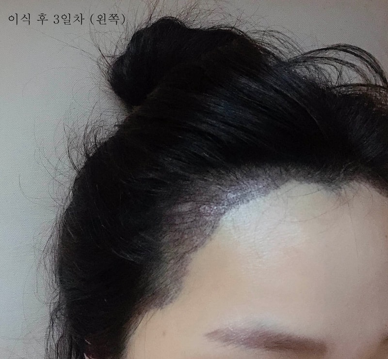 이식 후 3일차 왼쪽9.jpg