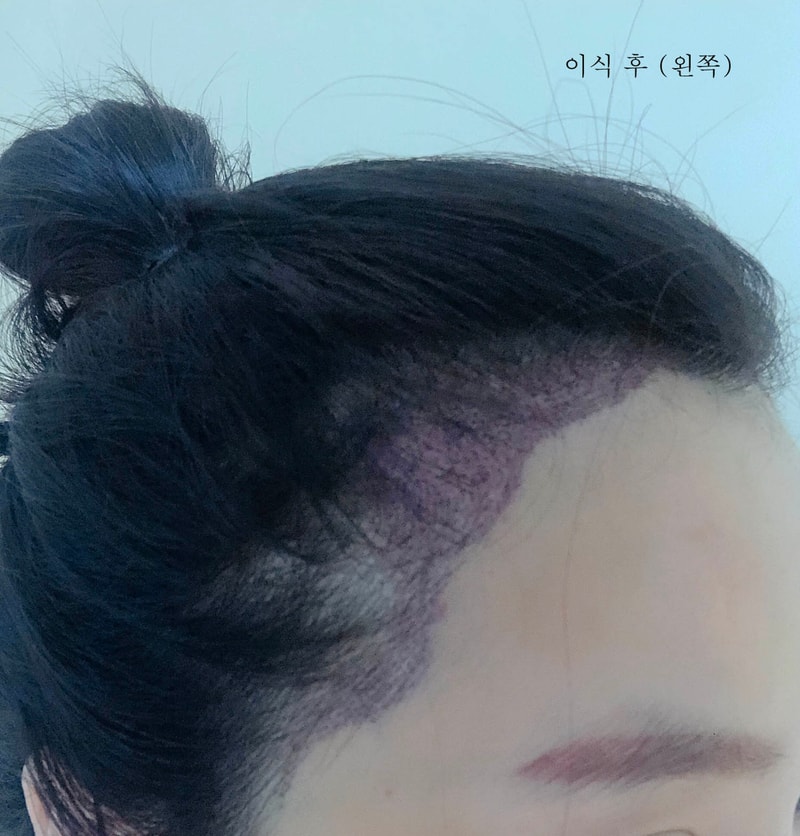 이식 후 왼쪽.jpg