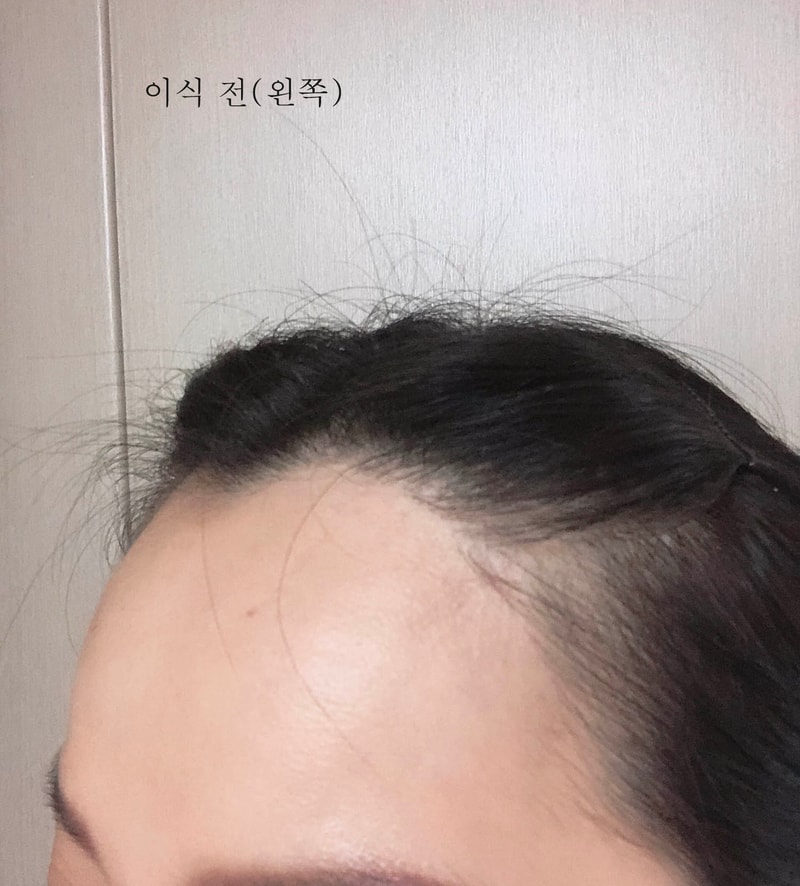 이식 전 왼쪽.jpg