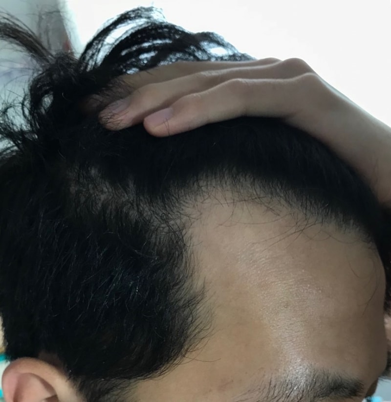 이식전오른쪽.jpg