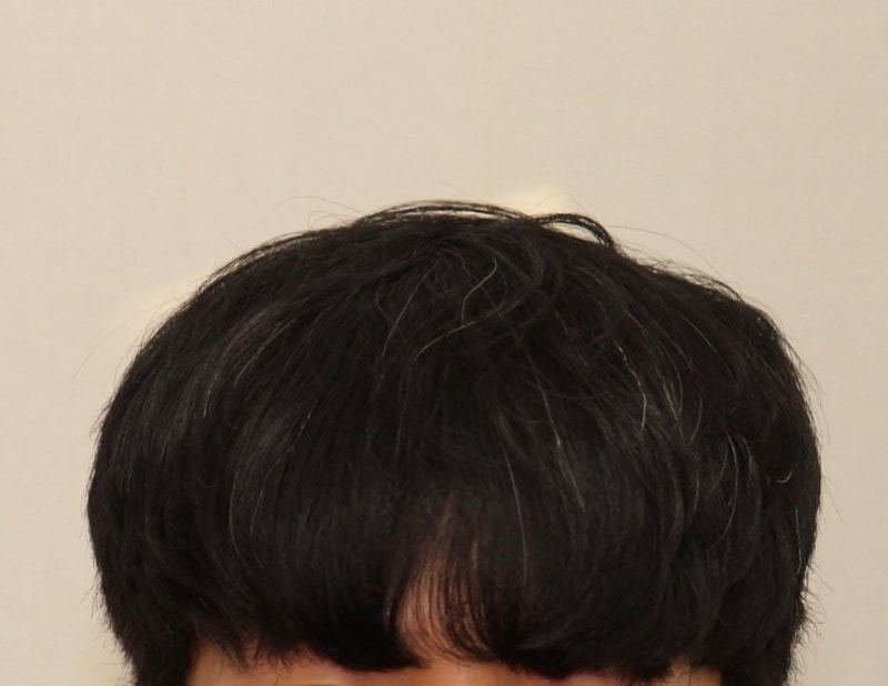 ニューヘアついに6ヶ月経過を見てきました。(病院の写真、自撮り写真)