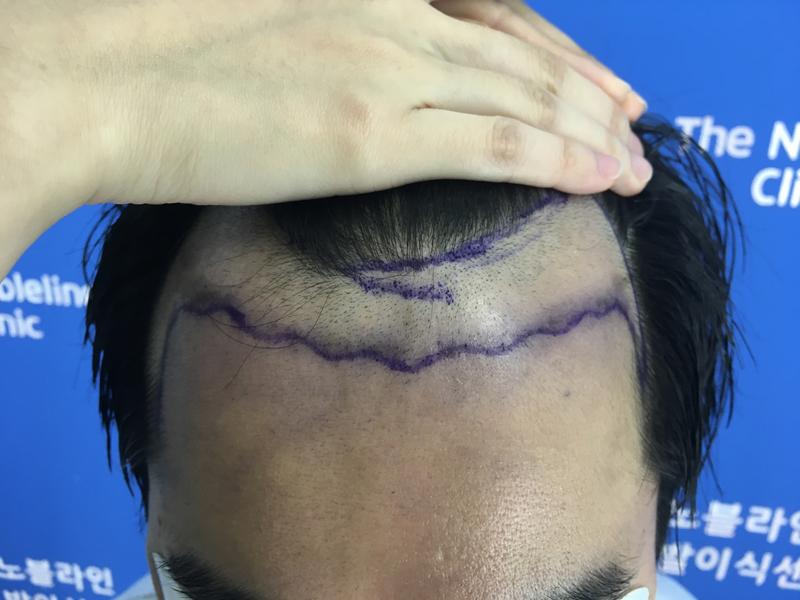 Late M-shaped hair loss of 4980 hair (1st day)