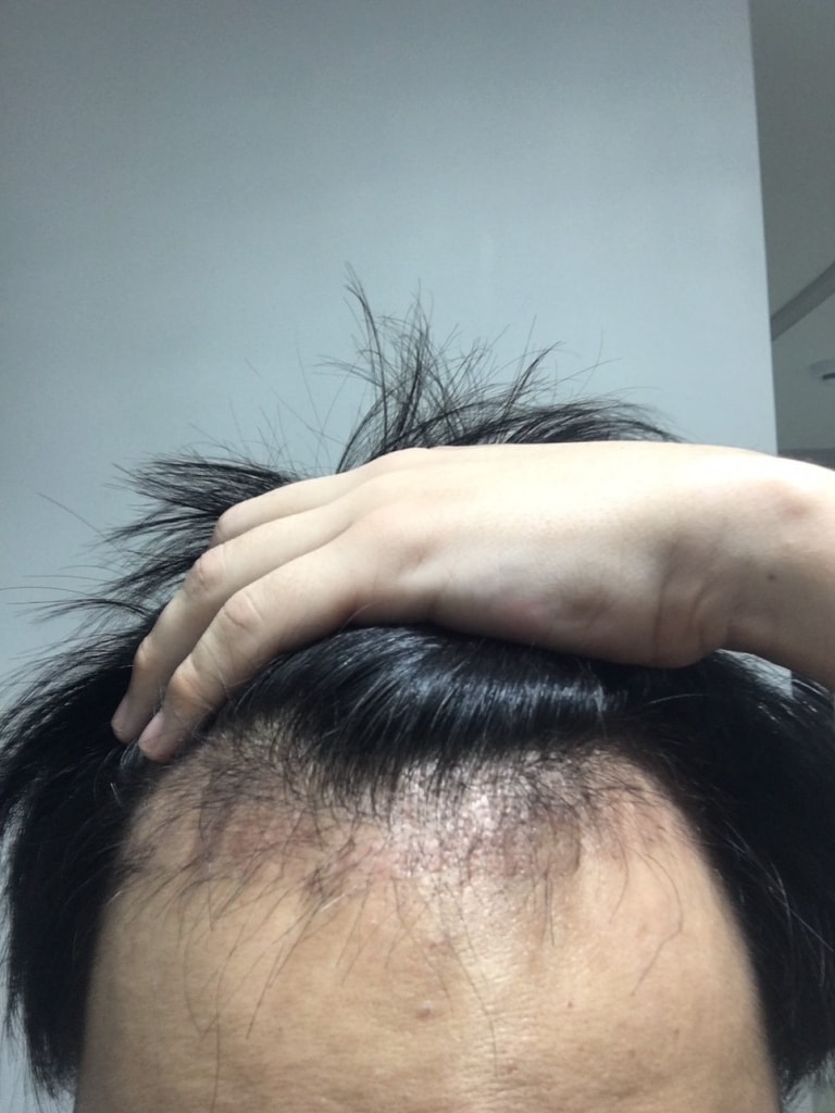 수술2개월차2.JPG