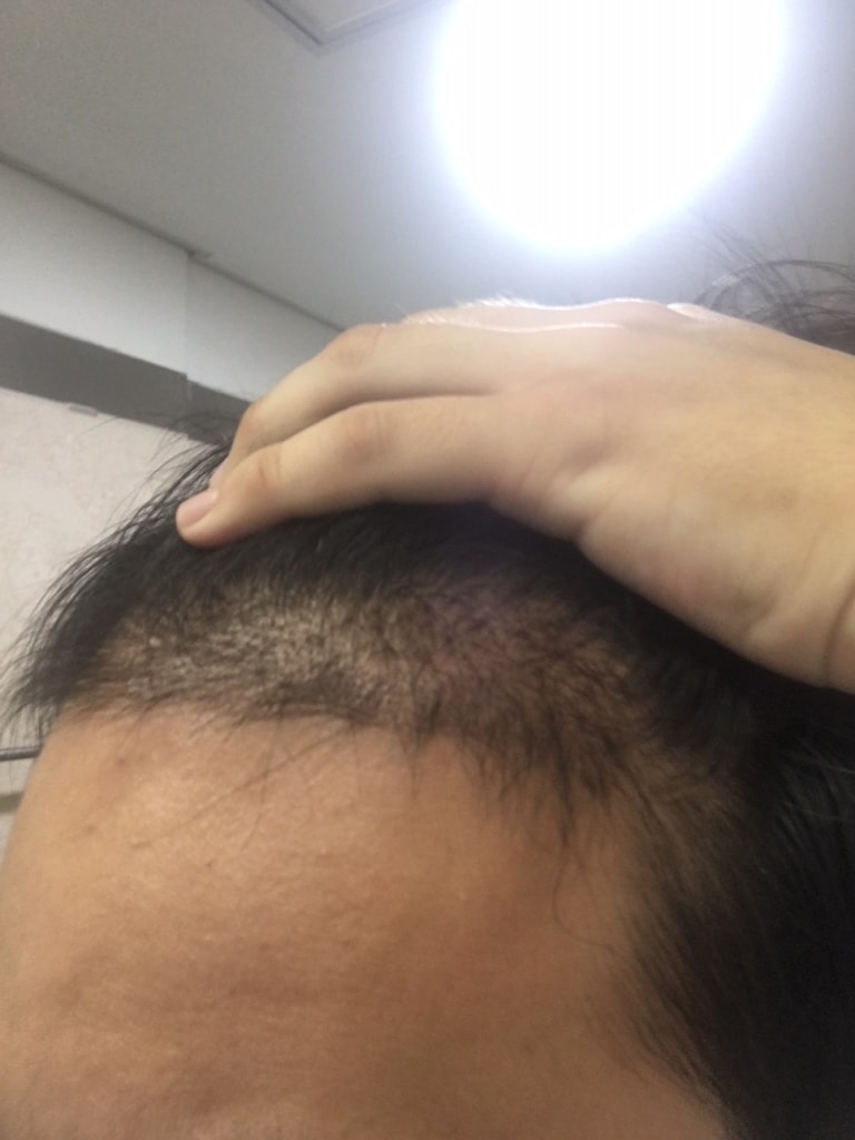 수술4개월차1.JPG