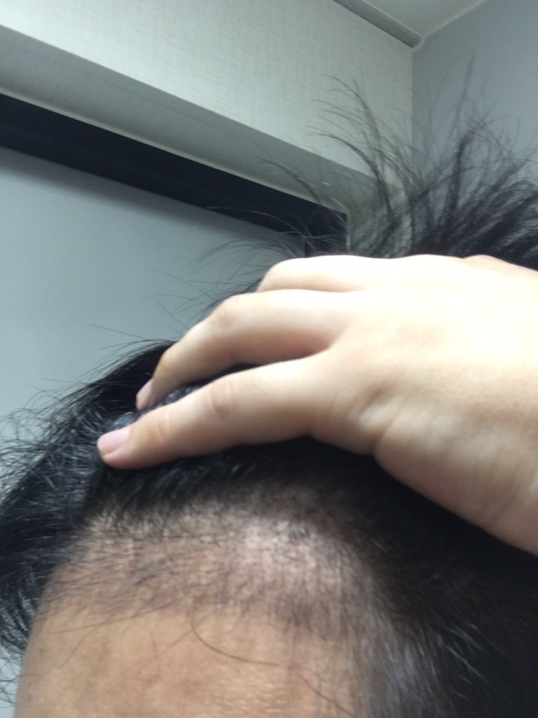 수술3개월차3.JPG