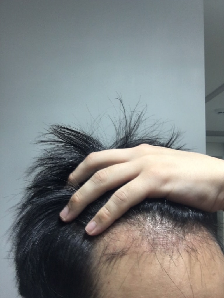 수술2개월차1.JPG