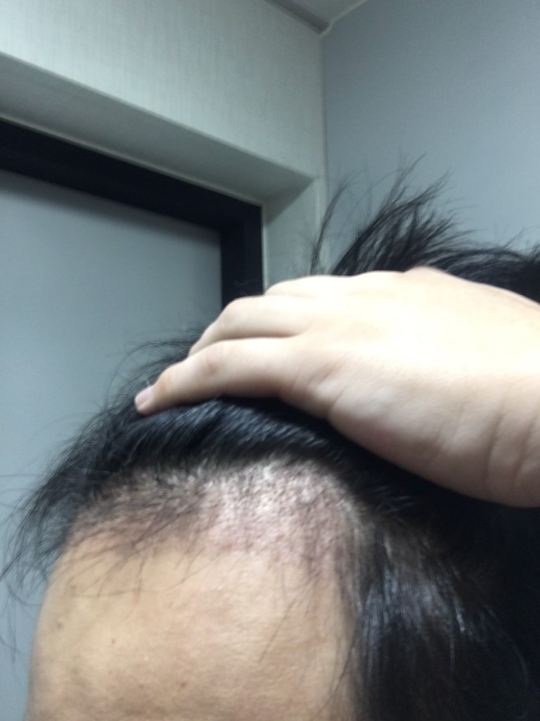 수술2개월차3.JPG