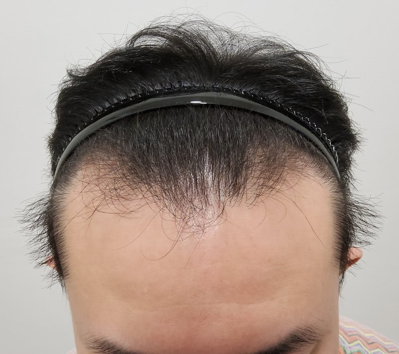 I regret getting my hair transplant early