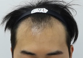 수술전 앞모습2.jpg