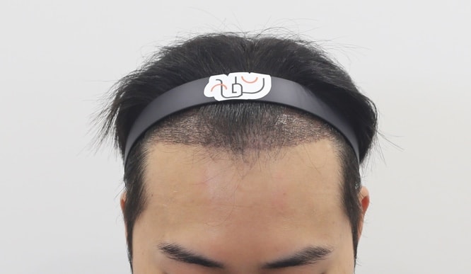 2주경과 앞모습.jpg