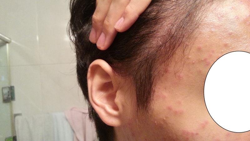 ニューヘア 非切開 1860毛包手術 3ヶ月になりました！
