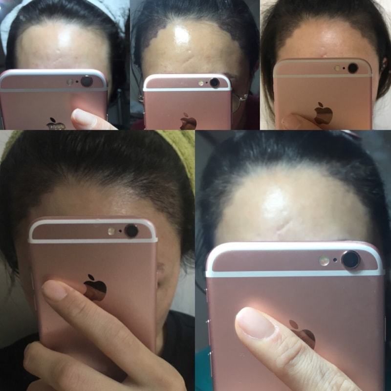 ヘアラインの毛髪移植が2ヶ月になりました