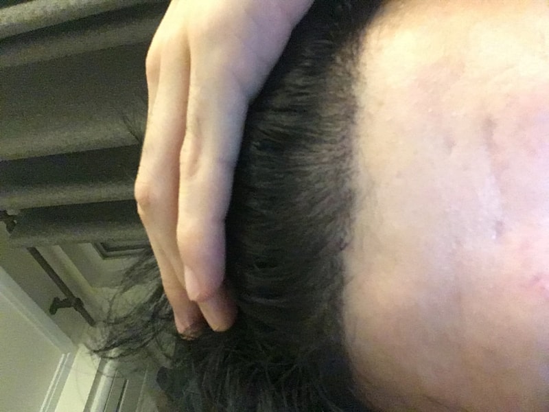 It's the second week of hair transplant