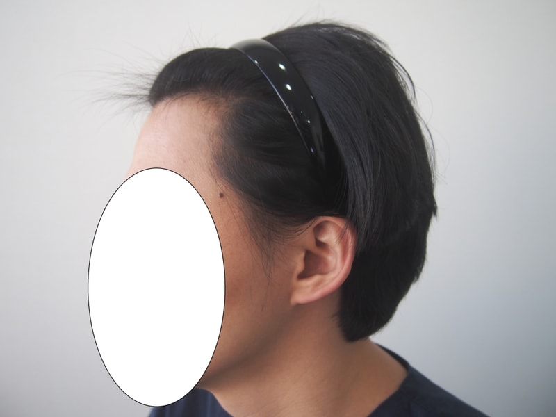 1600毛包手術前後