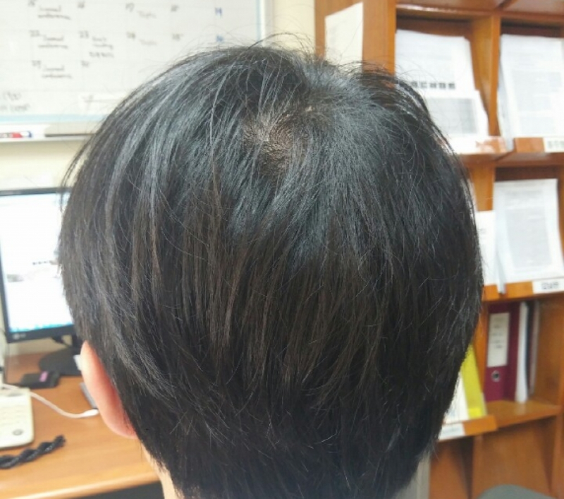 ポヘアボックスカット？ で 1580毛包 植え後記