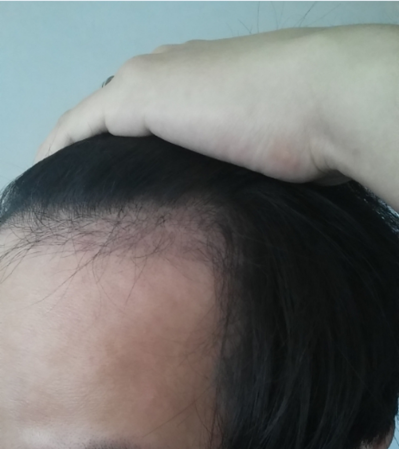 手術3ヶ月目、家で一枚撮ります。