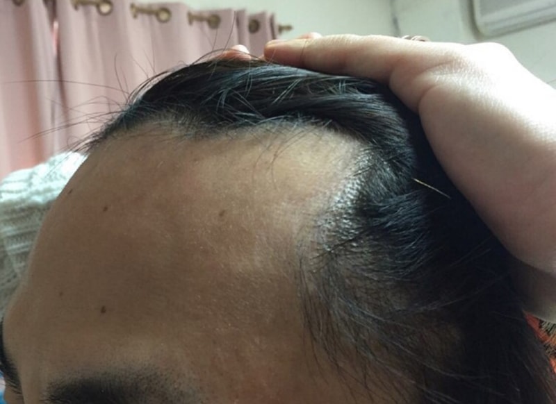 M-shaped hair loss 1000 hair follicle non-cut support is needed