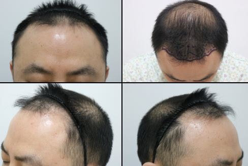 1 year of treatment for the crown of M.J. surgery