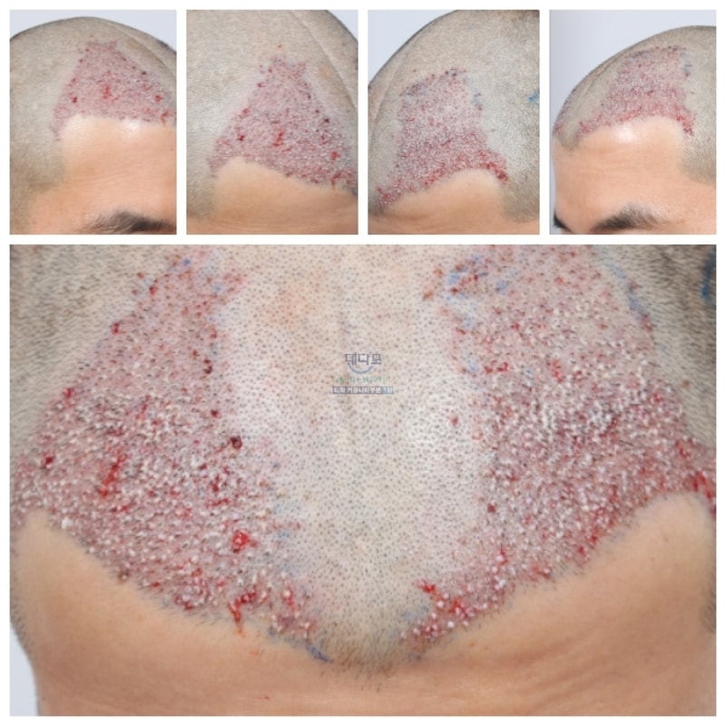 Busan Forehead 5th Month Review