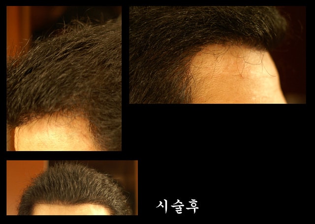 시술후.jpg