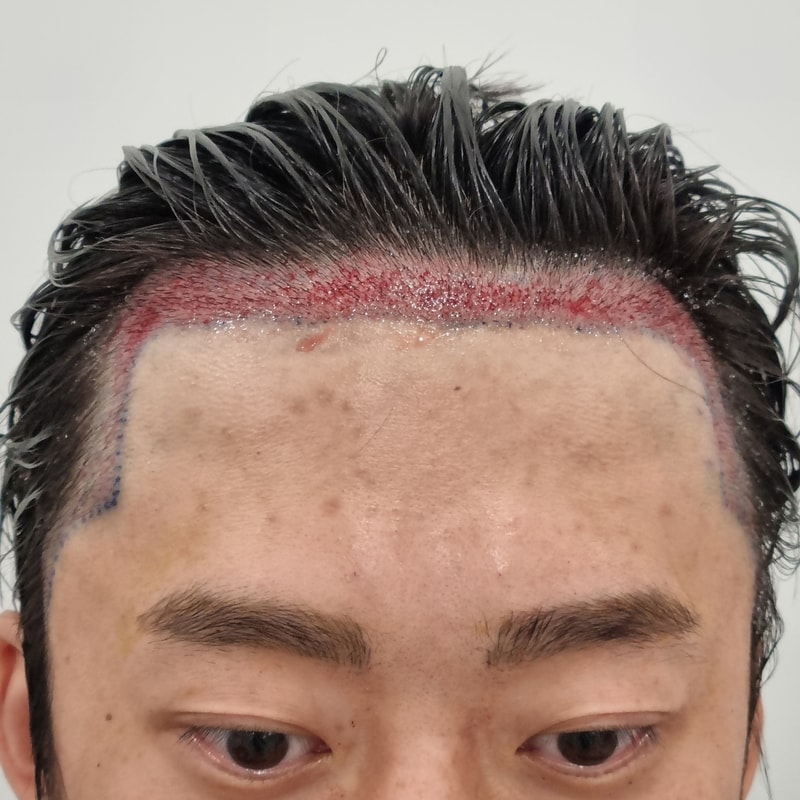 이식정면.jpg
