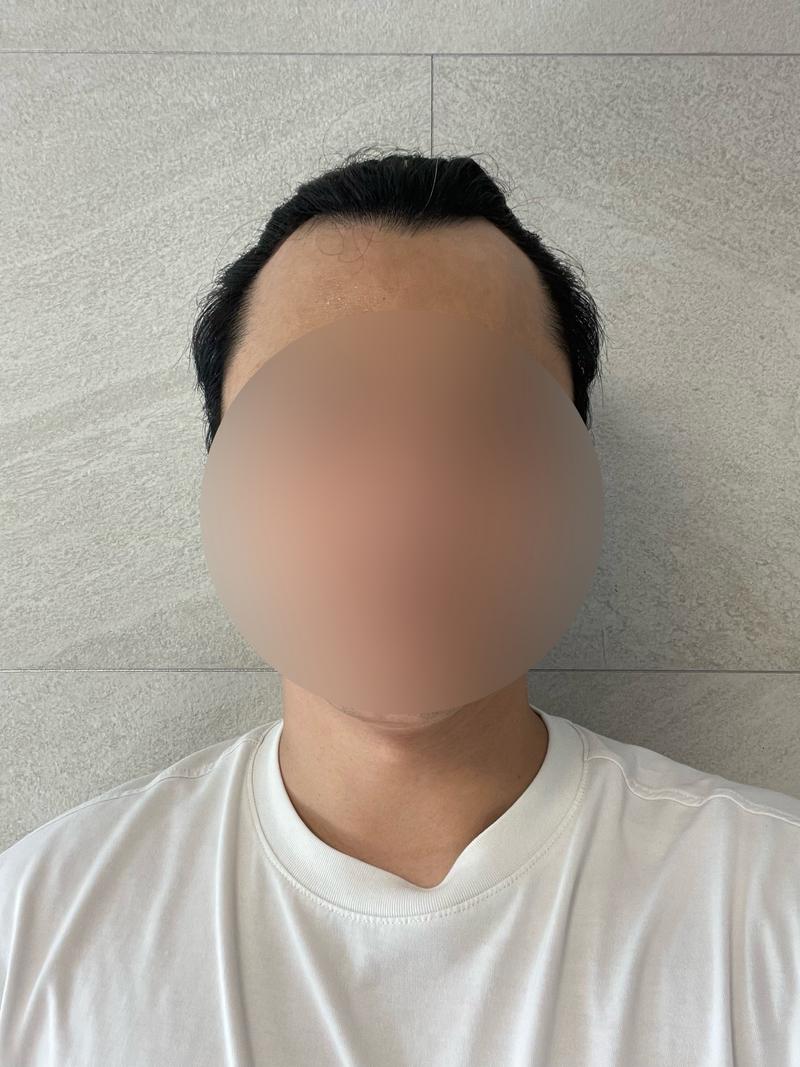 모모성형외과 모발이식 3개월차 후기