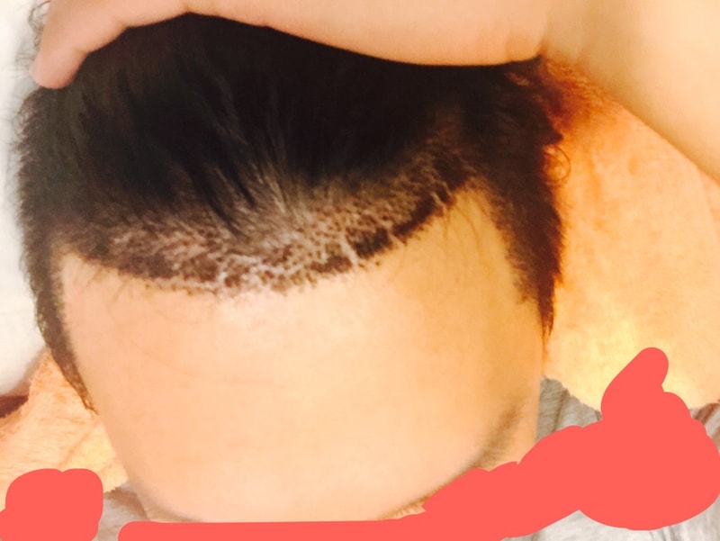 非切開10日目