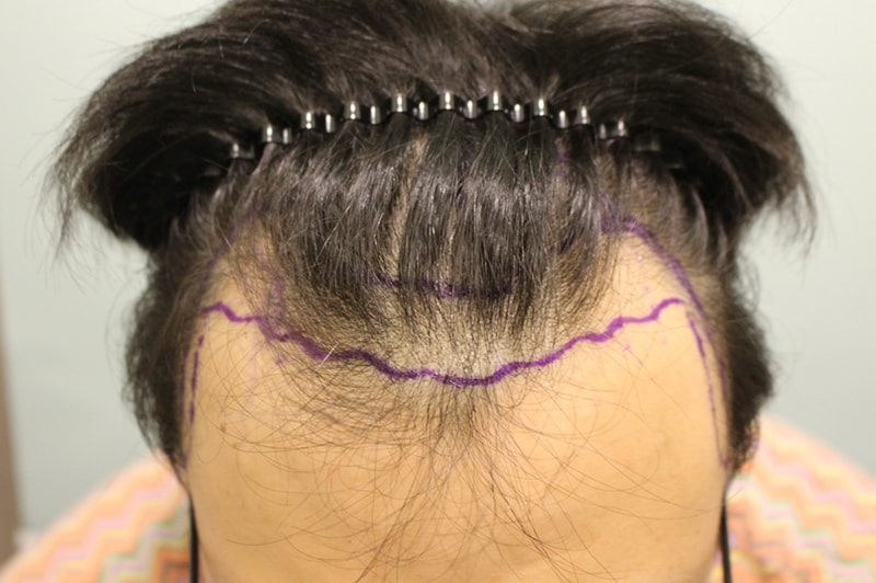 ヘアライン~整数密度補強手術をして4ヶ月