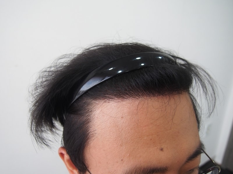 Maternal 1700 hair follicle nasal incision was performed.(Photo by 4 months)