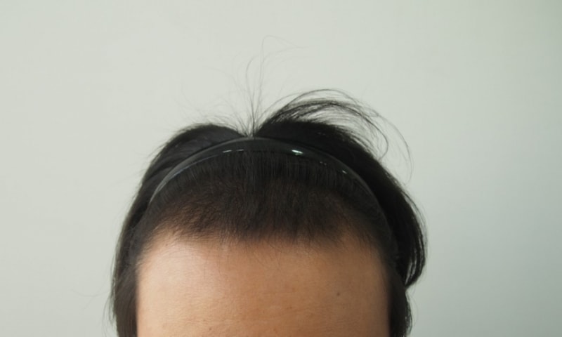 Maternal 1700 hair follicle nasal incision was performed.