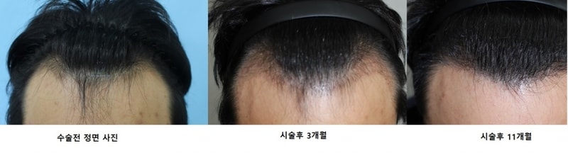 I'm posting a photo of the 11th month of Hanive 3,000 hair incision.