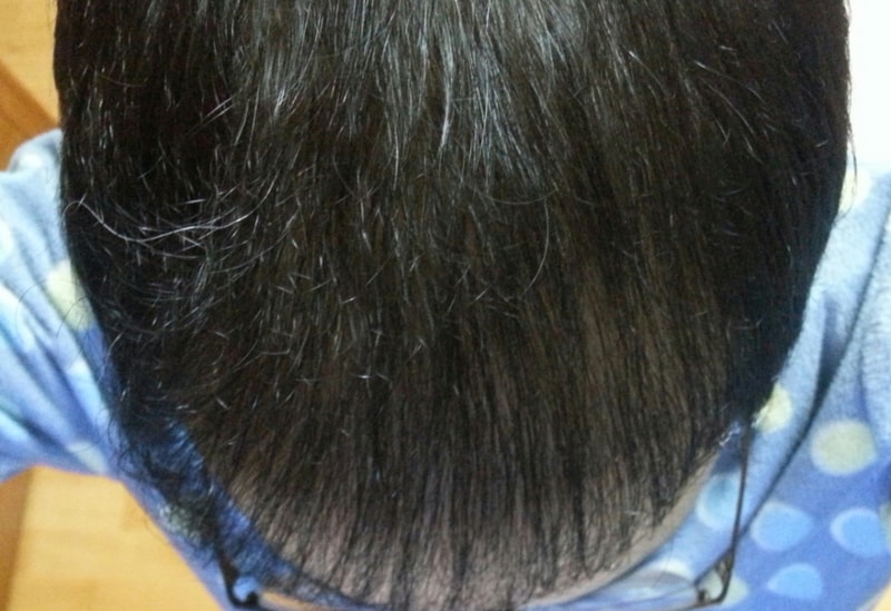 수술후309일1.jpg