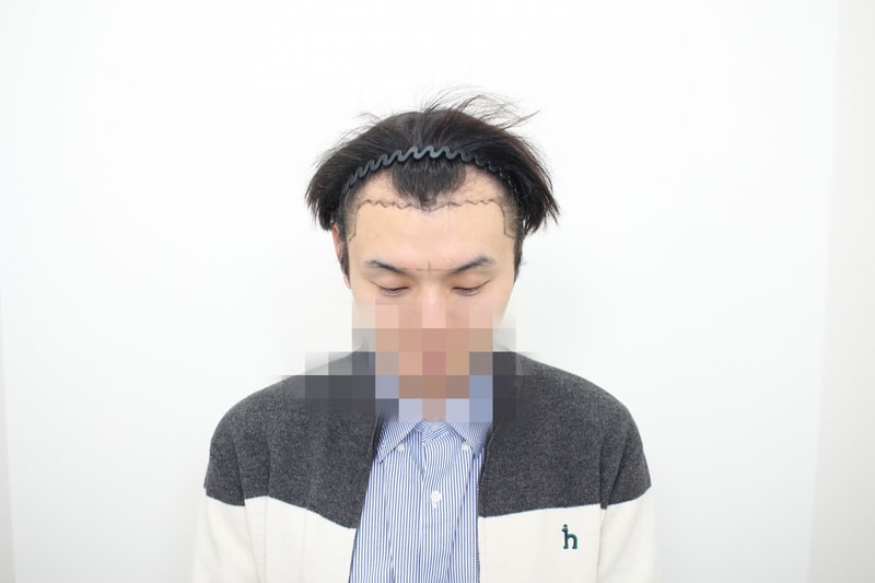 수술당일 디자인 후-2.jpg