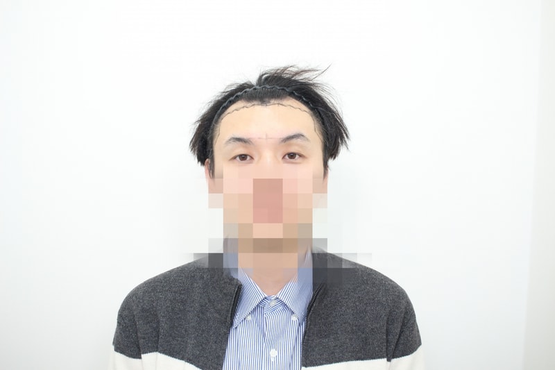 수술당일 디자인 후-1.jpg