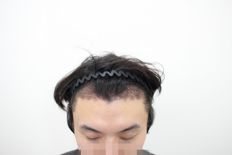 18일차 내원사진-1.jpg