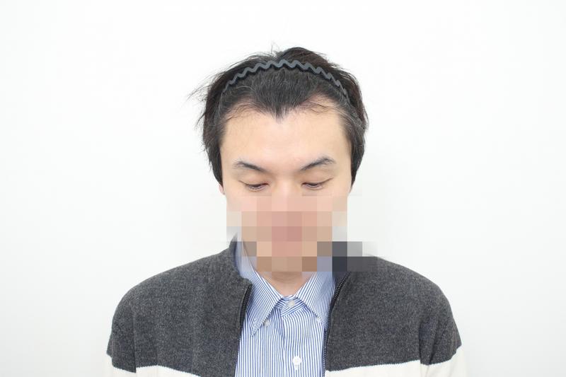 [경과체크] 모발이식 모프로,문건학원장님 ★모프로의원, 비절개 라인컷 18일차 입니다.