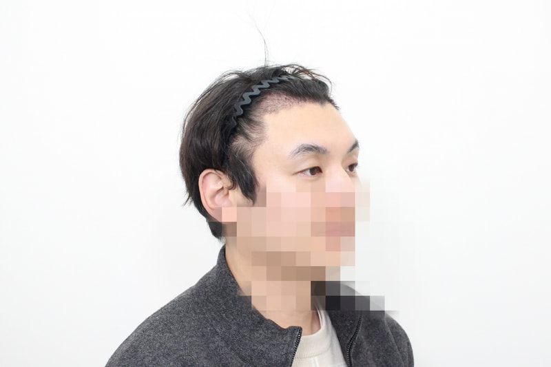 18일차 내원사진-2.jpg