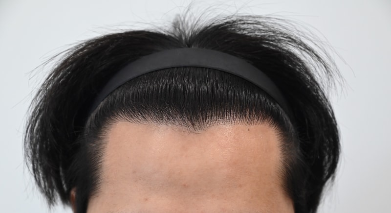 It's been a year since MoM clinic's 3,200 non-cut hair transplant.