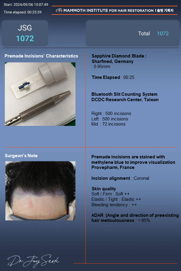 Apgujeong Mamos Hairline Hair Transplantation Day Review