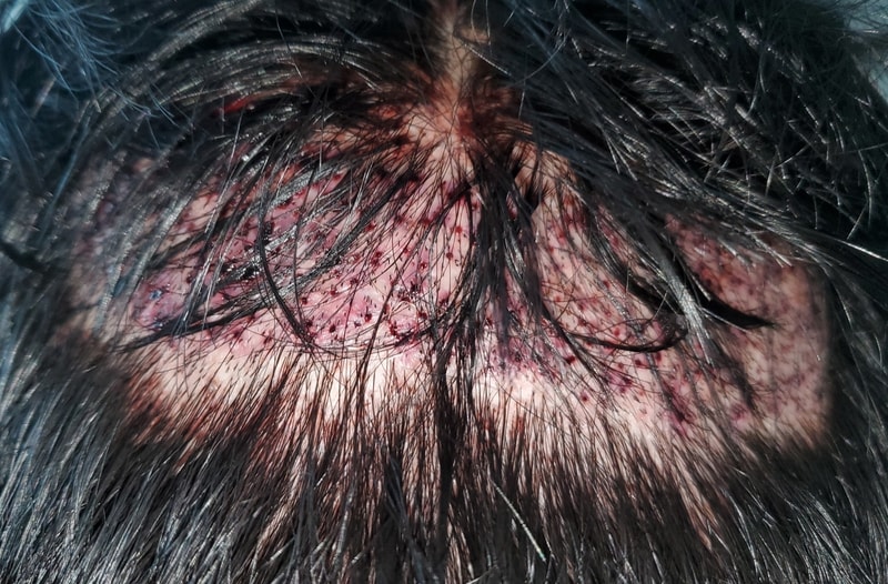 Back donor after 3 days.jpg