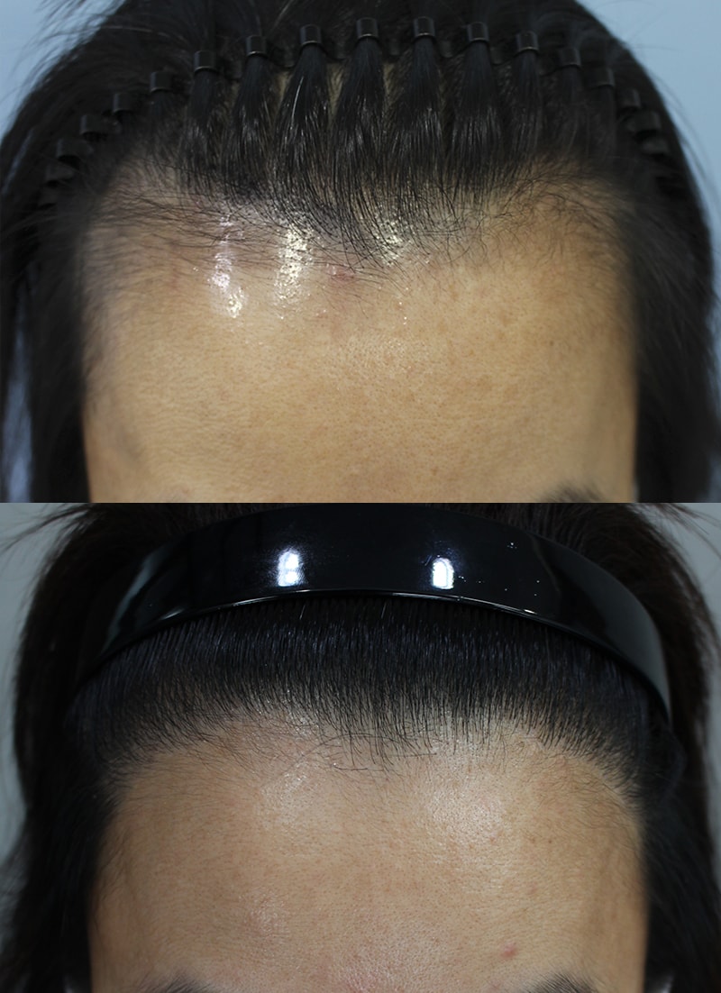 Eight months after the hairline transplant